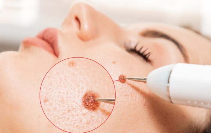 Understanding Mohs Surgery for Skin Cancer Treatment