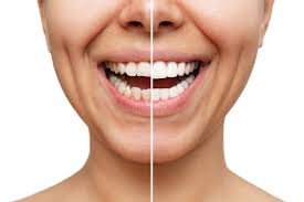 Aesthetic Differences Between Porcelain and Composite Veneers