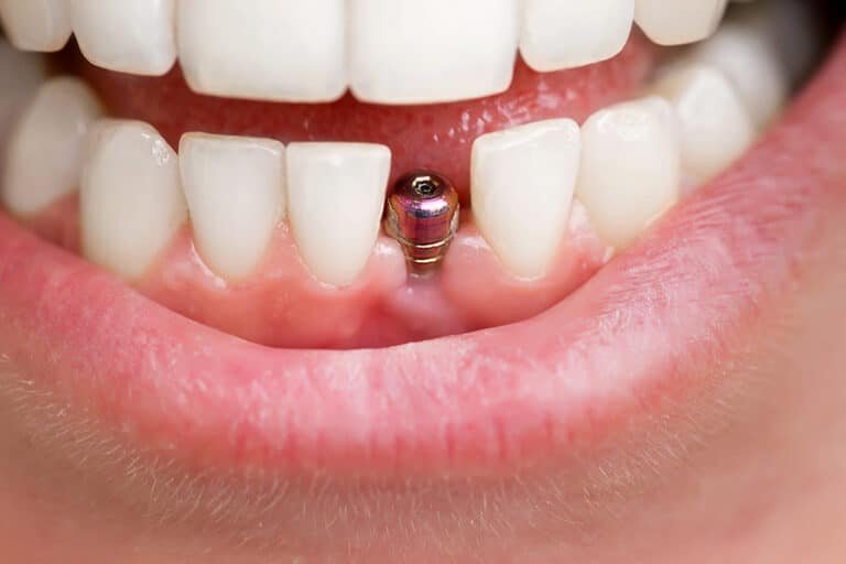 The Long-Term Care and Maintenance of Dental Implants